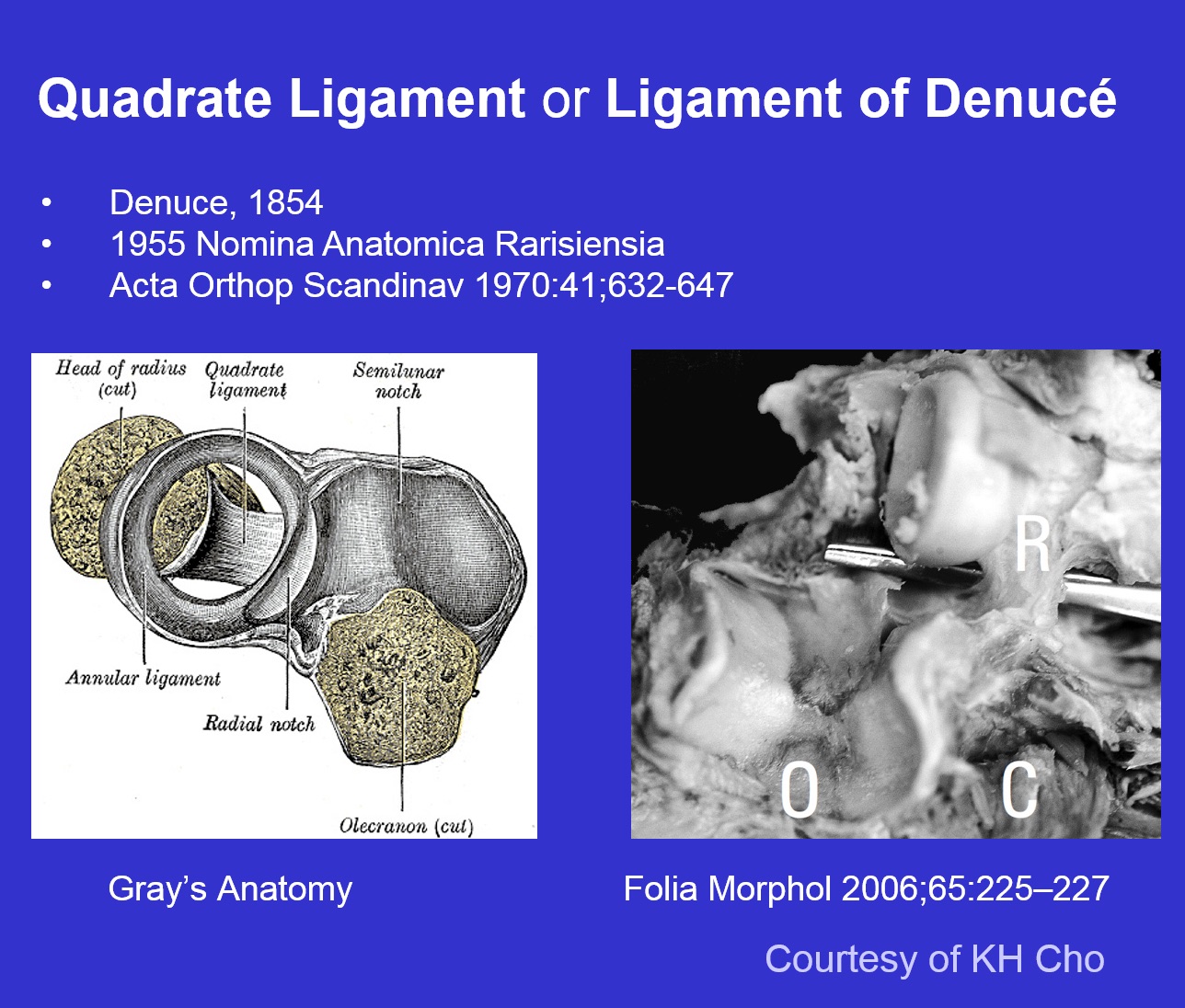 Figure 4 for case Quadrate ligament of elbow ( RID2051 )